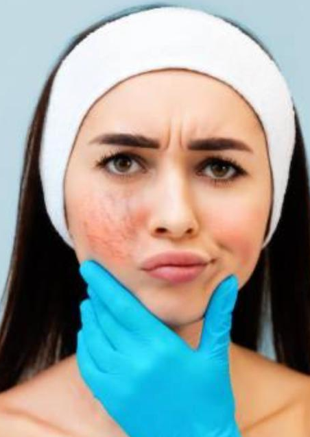 Was hilft bei Couperose und Rosacea?