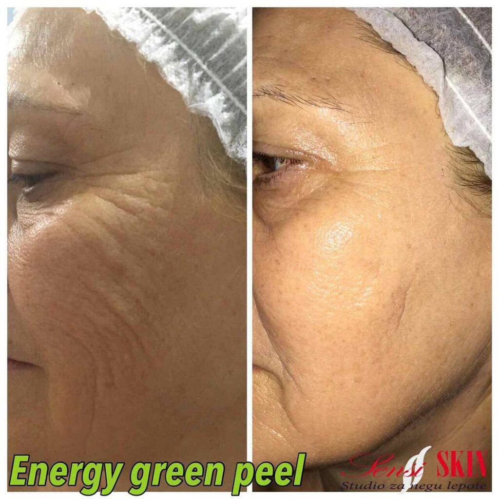 Behandlungsergebnis Green Peel-Behandlung