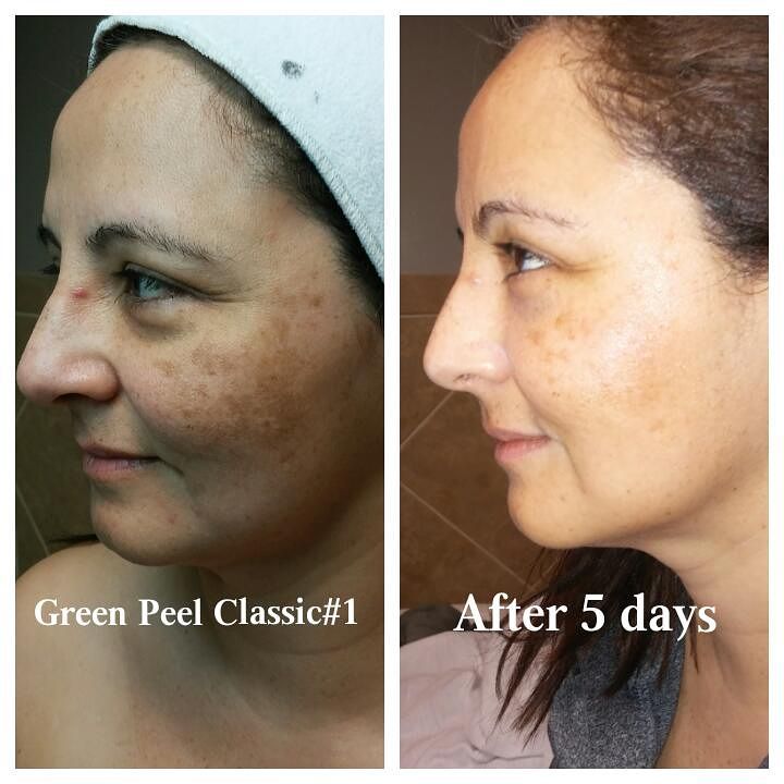 Behandlungsergebnis Green Peel-Behandlung