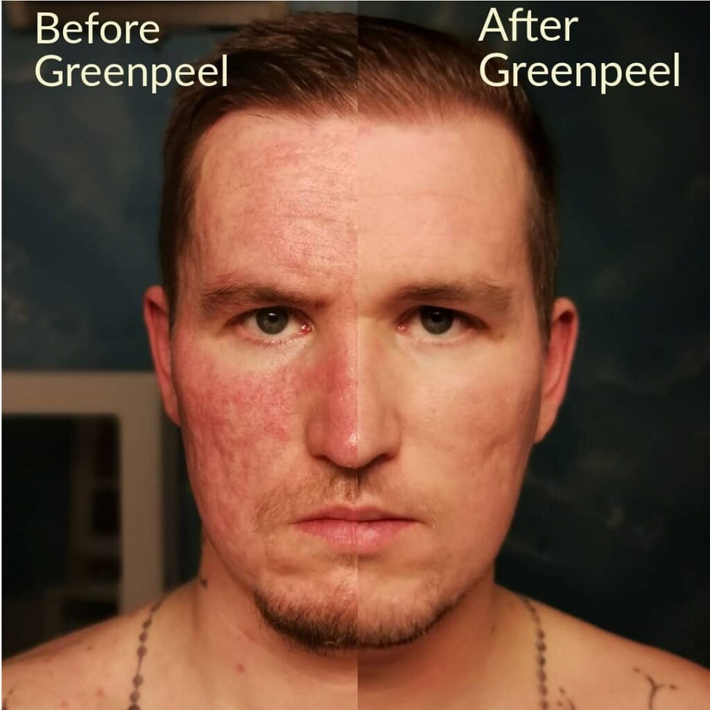 Behandlungsergebnis Green Peel-Behandlung