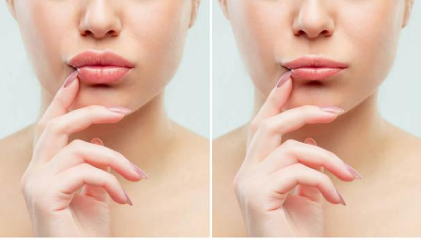 Lippenpigmentierung