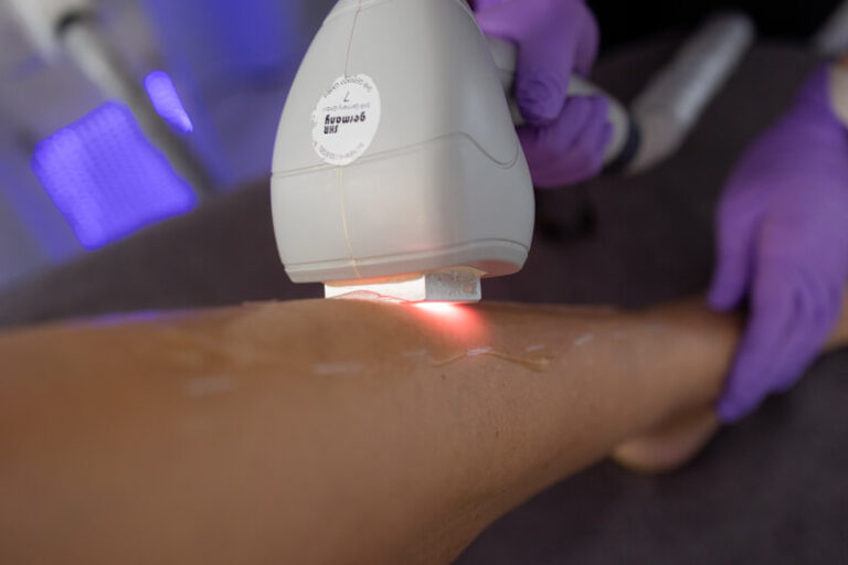 Dauerhafte Haarentfernung mit dem 3W-Laser in Stuttgart
